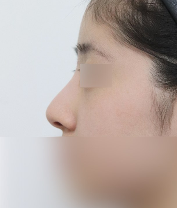 코재수술 전 옆모습
