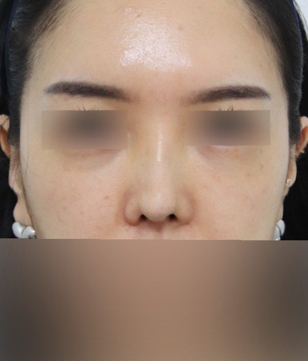 코재수술 후 정면