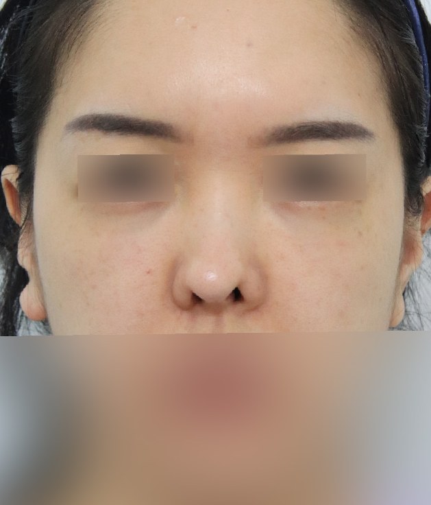 코재수술 전 정면