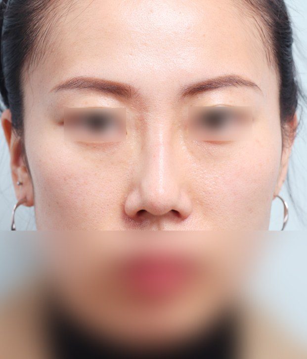 코재수술 후 정면