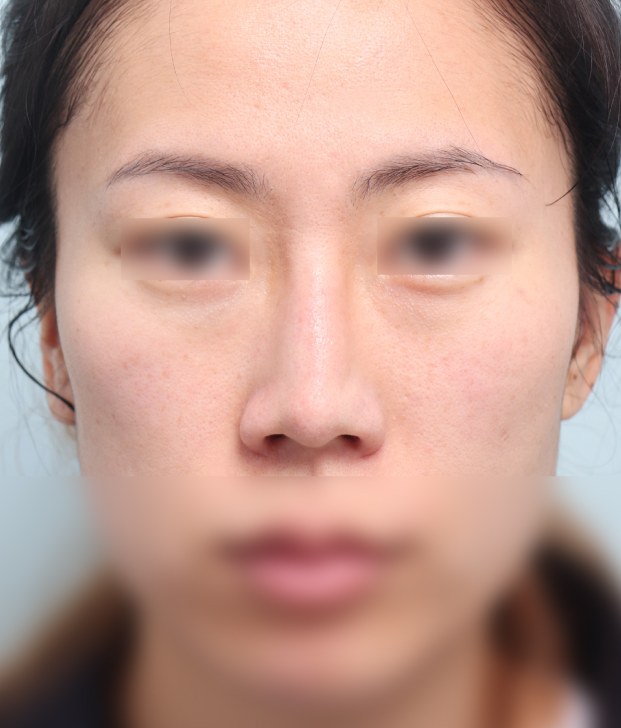 코재수술 전 정면