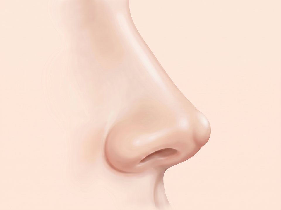 Ilustrasi hidung dilihat dari samping — ujung implan sedikit menonjol di bawah kulit ujung hidung