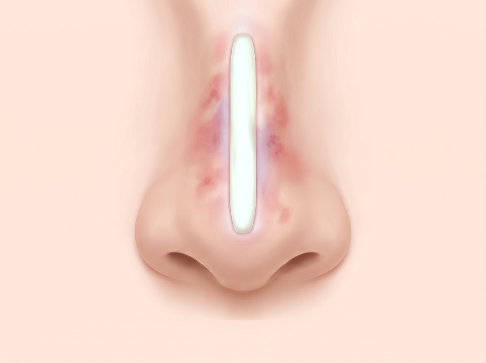 정면에서 본 코 일러스트 — 보형물이 비쳐 보이고 그 위 피부색이 붉게 변한 모습