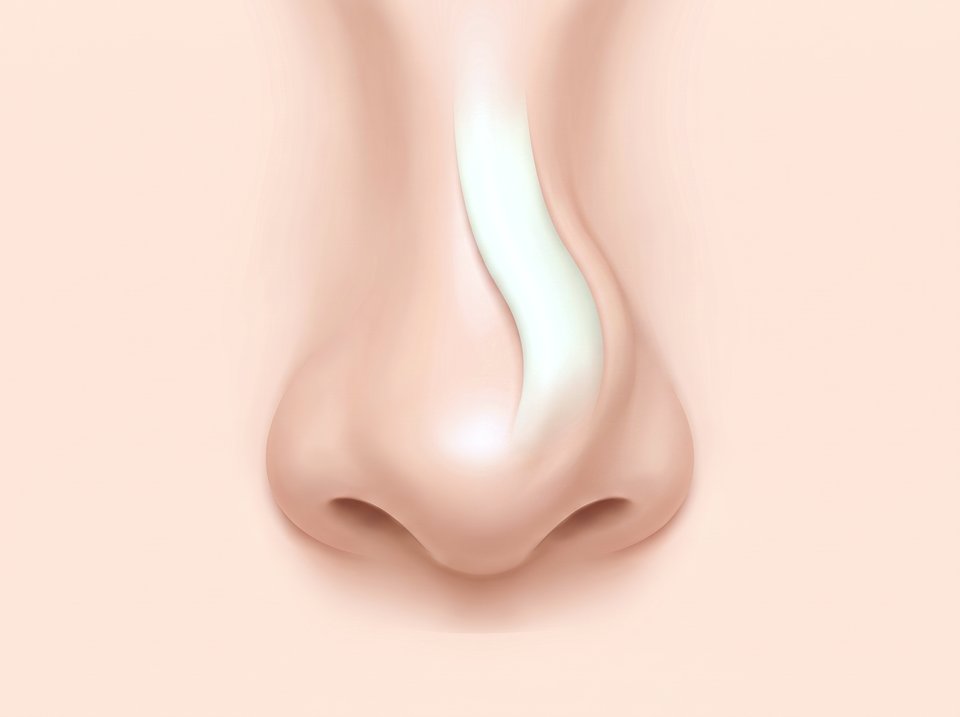 정면에서 본 코 일러스트 — 보형물이 코 중심선에서 벗어나 한쪽으로 치우친 모습