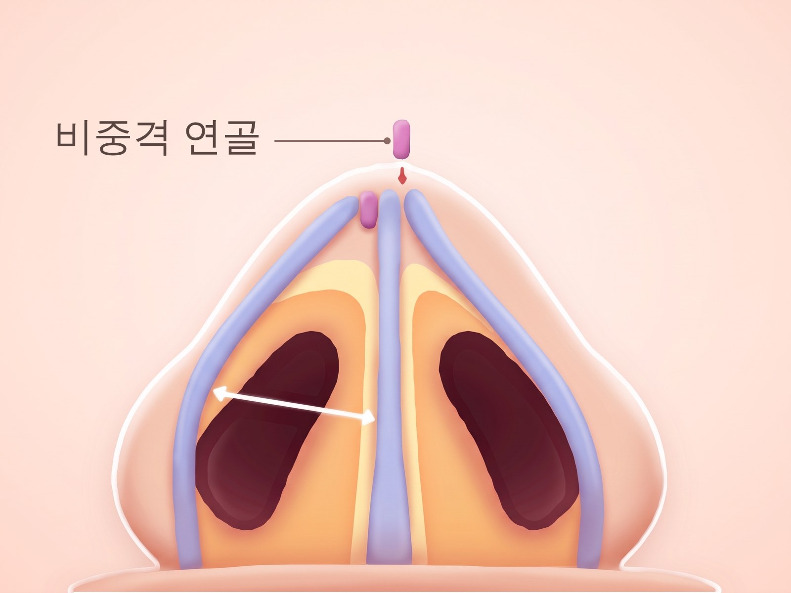 비중격 연골 이식편을 넣은 코 내부를 아래에서 본 일러스트