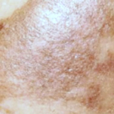 Ảnh phóng to vùng da má có nám lan rộng