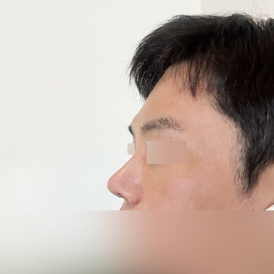 수술후기 게시판에 올라온 코재수술 후기 카드