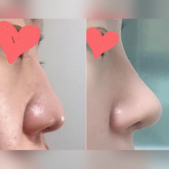 Ảnh thu nhỏ bài review phẫu thuật mũi — Mình đã cải thiện mũi củ tỏi và mũi khoằm bằng phẫu thuật!