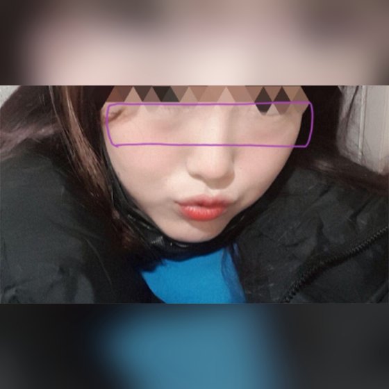 Ảnh thu nhỏ bài review phẫu thuật mũi — Review thật lòng về tái phân bố mỡ dưới mắt (tròn một tháng)
