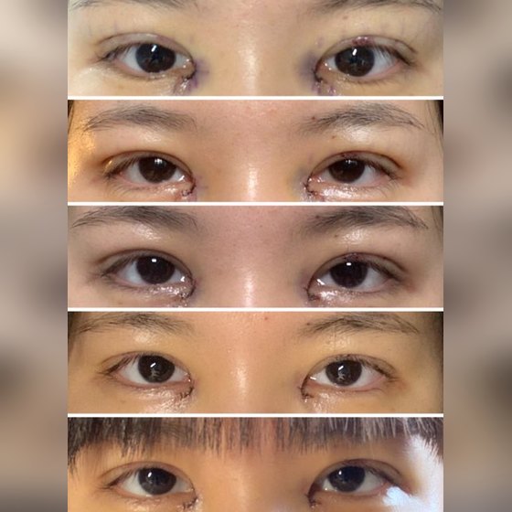 Ảnh thu nhỏ bài review phẫu thuật mắt — Review mở mí một phần + mở góc mắt trong + chỉnh dáng mắt