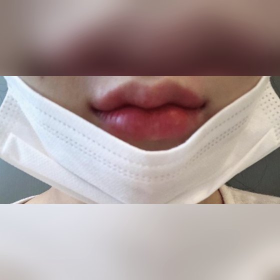 Ảnh thu nhỏ bài review tiêm thẩm mỹ — Review thật lòng về tiêm filler môi