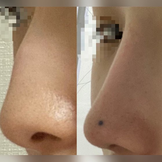 Ảnh thu nhỏ bài review phẫu thuật mũi — Review cải thiện mũi khoằm