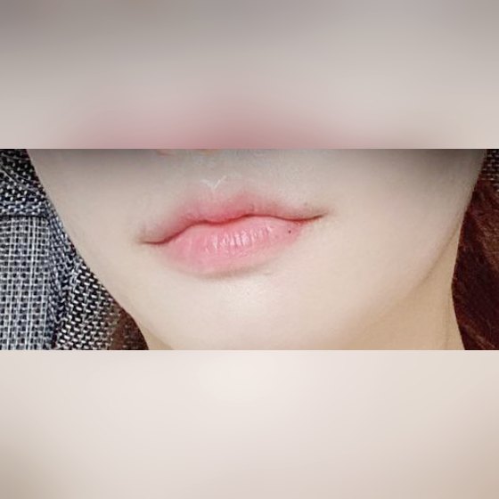 Ảnh thu nhỏ bài review tiêm thẩm mỹ — Mình chỉ tiêm filler ở đây thôi!~
