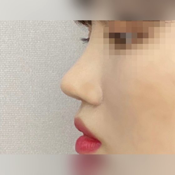 Ảnh thu nhỏ bài review phẫu thuật mũi — Mình đã sửa mũi lại rồi!