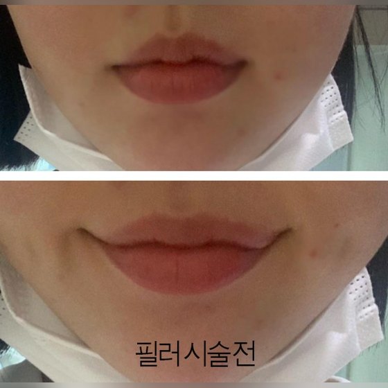 쁘띠 후기 게시글 썸네일 — 입술필러 왜 유명한지 알겠네요
