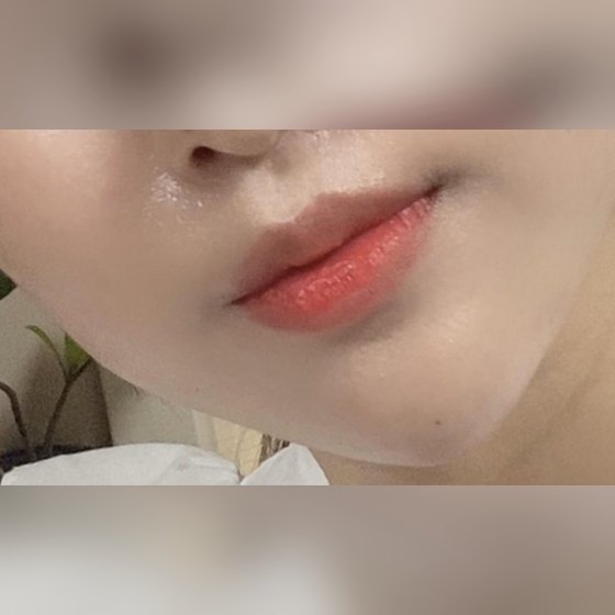Ảnh thu nhỏ bài review thẩm mỹ không xâm lấn — Thoát cảnh cằm lẹm nhờ filler cằm!!