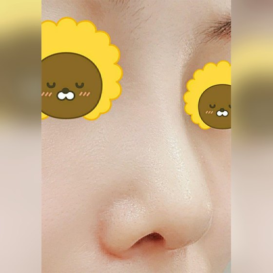 Ảnh thu nhỏ bài review phẫu thuật mũi — Review phẫu thuật mũi chức năng