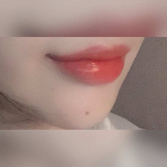 Ảnh thu nhỏ bài review thẩm mỹ không xâm lấn — Review filler môi nè