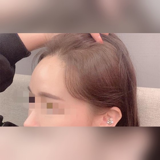 Ảnh thu nhỏ bài review thẩm mỹ không xâm lấn — Mình đã tiêm 4cc filler trán