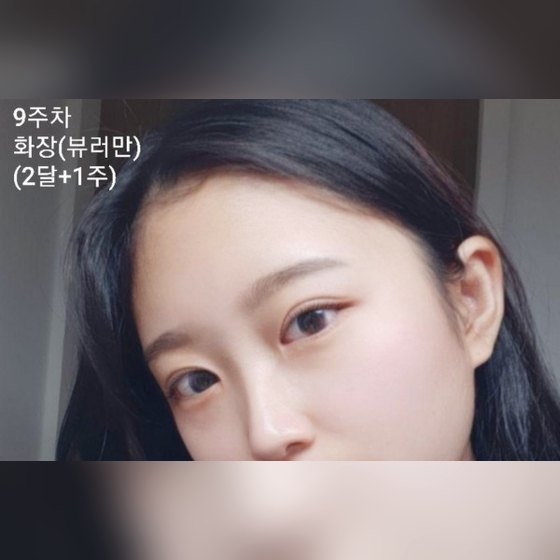 눈성형 후기 게시글 썸네일 — 인라인/앞트임/눈매교정 후기