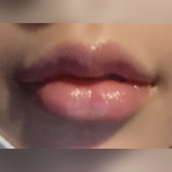 Ảnh thu nhỏ bài review thẩm mỹ không xâm lấn — Filler môi quá đỉnh~~