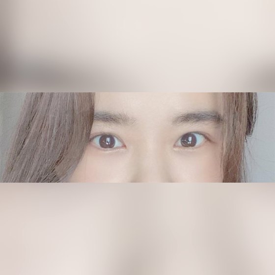 Ảnh thu nhỏ bài review phẫu thuật mắt — Mắt lờ đờ.. mắt xúc xích, mình đã phẫu thuật lại rồi!