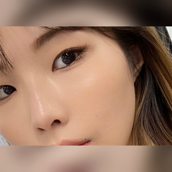 Ảnh thu nhỏ bài review thẩm mỹ không xâm lấn — Filler gò má trước, độ đầy đặn tuyệt vời!!