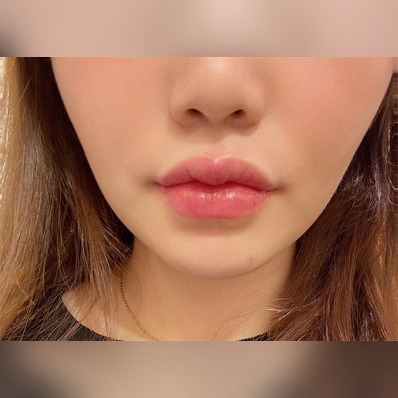 Ảnh thu nhỏ bài review thẩm mỹ không xâm lấn — Đúng là nơi làm môi hàng đầu thật haha