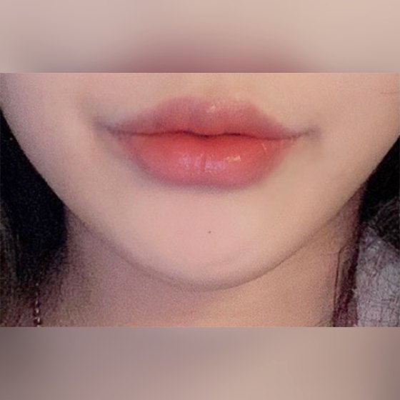 Ảnh thu nhỏ bài review thẩm mỹ không xâm lấn — Lần đầu tiên trong đời tiêm filler môi..!