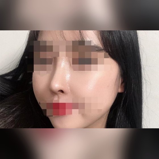 Ảnh thu nhỏ bài review phẫu thuật mũi — Rất hài lòng với phẫu thuật mũi!!