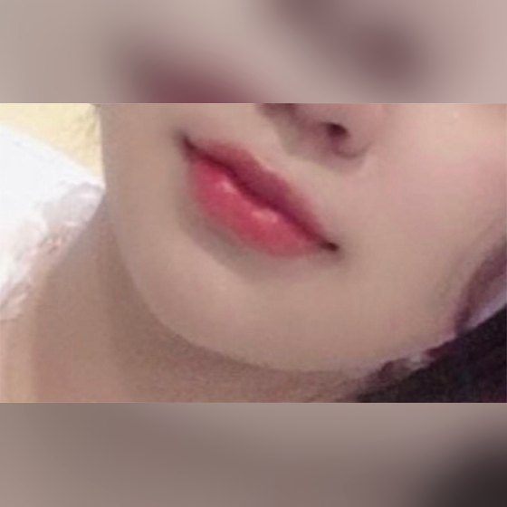 Ảnh thu nhỏ bài review thẩm mỹ không xâm lấn — Quá hài lòng với filler môi haha