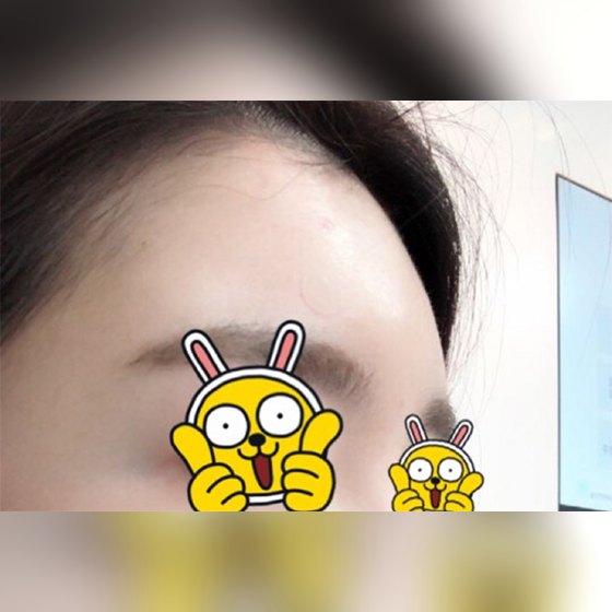 Ảnh thu nhỏ bài review thẩm mỹ không xâm lấn — Cực kỳ hài lòng với filler trán