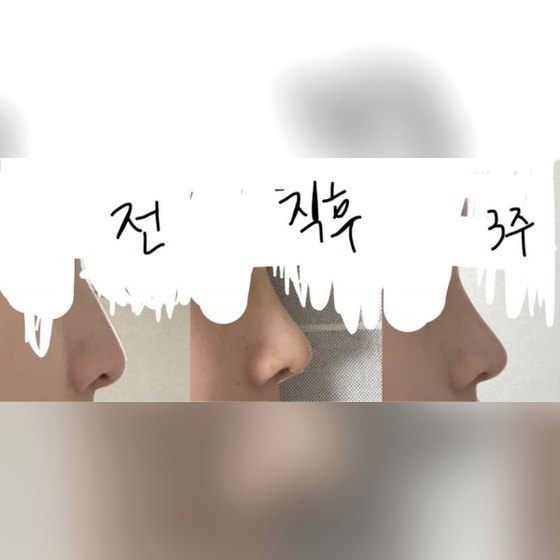 코성형 후기 게시글 썸네일 — 제갈정재 원장님께 코성형 추천해용!!!^-^