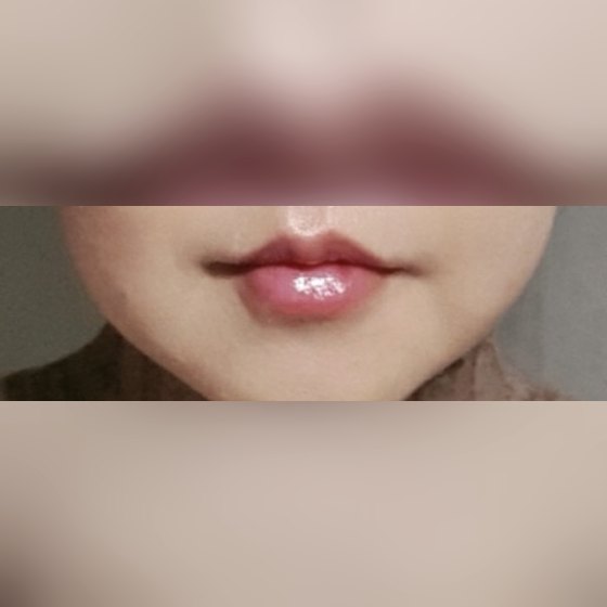 Ảnh thu nhỏ bài review thẩm mỹ không xâm lấn — Mình đã chỉnh khóe miệng bị trễ xuống rồi!