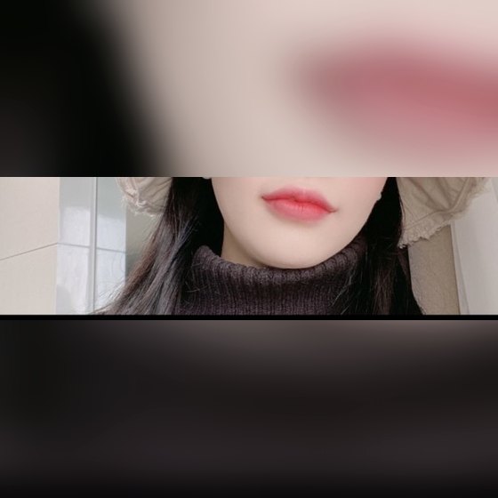 Ảnh thu nhỏ bài review thẩm mỹ không xâm lấn — Hài lòng với filler môi!!!!>_<