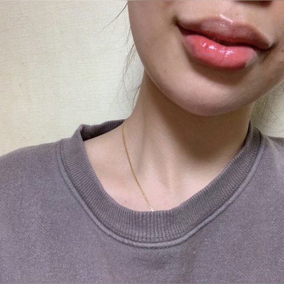 Ảnh thu nhỏ bài review thẩm mỹ không xâm lấn — Rất hài lòng với filler môi~