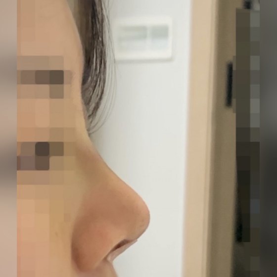 Ảnh thu nhỏ bài review phẫu thuật mũi — Để lại review phẫu thuật mũi nè hihi