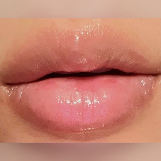 Ảnh thu nhỏ bài review thẩm mỹ không xâm lấn — Đúng là nơi làm filler môi đỉnh thật~