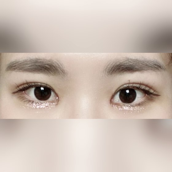 Ảnh thu nhỏ bài review phẫu thuật mắt — Mình cực kỳ hài lòng!