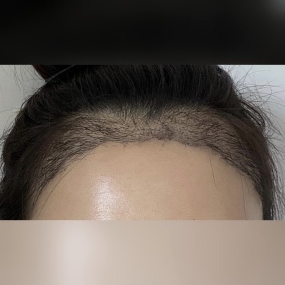 Ảnh thu nhỏ bài review khác — Mình đã cấy tóc vùng chân tóc^^