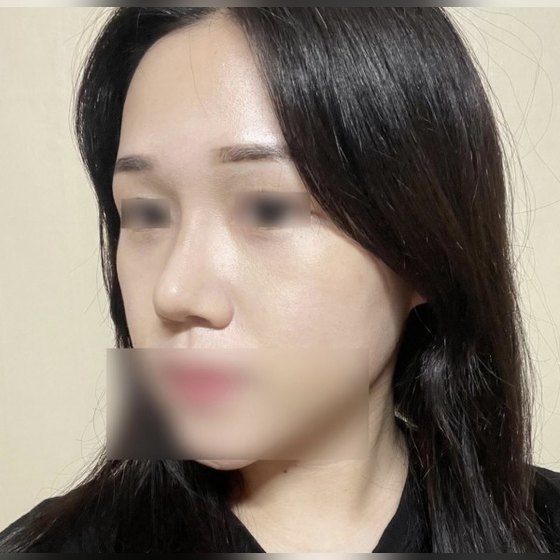 Ảnh thu nhỏ bài review phẫu thuật mũi — Review mũi củ tỏi + mũi khoằm~~