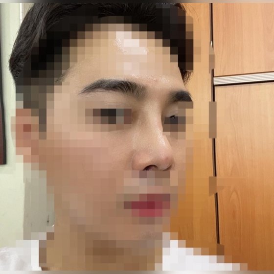 Ảnh thu nhỏ bài review thẩm mỹ mũi — Để lại review thẩm mỹ mũi nam giới nè hihi, cực kỳ hài lòng!