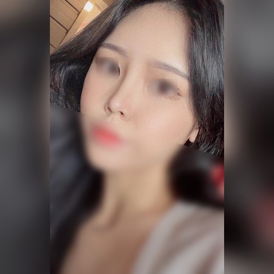 Ảnh thu nhỏ bài review thẩm mỹ mũi — Nâng mũi được 2 tháng rồi nè~