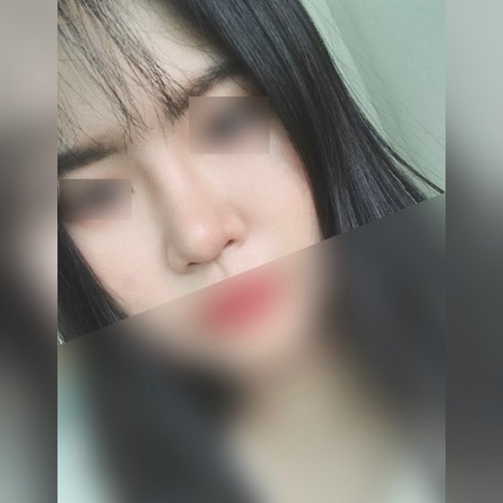 Ảnh thu nhỏ bài review thẩm mỹ mũi — Thoát khỏi nỗi stress vì mũi củ tỏi rồi nè!