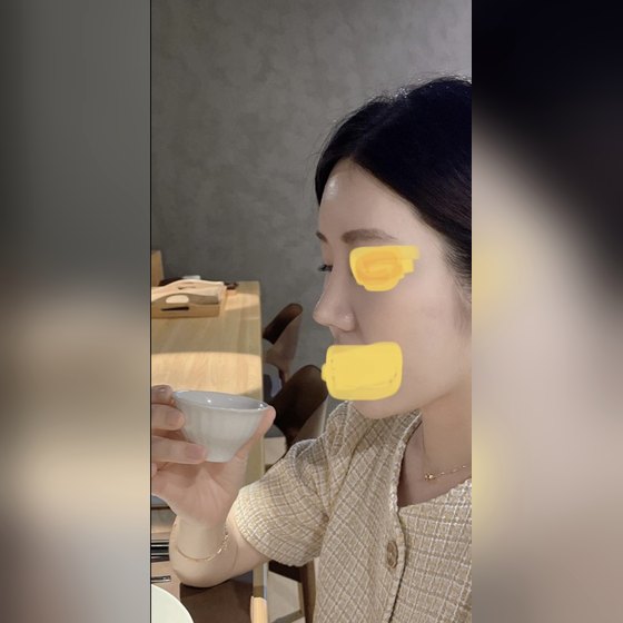 Ảnh thu nhỏ bài review thẩm mỹ mũi — Review phẫu thuật mũi!!