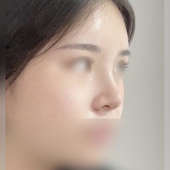 Ảnh thu nhỏ bài review thẩm mỹ mũi — Review chỉnh mũi củ tỏi !!