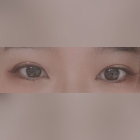 Ảnh thu nhỏ bài review thẩm mỹ mắt — Hoàn toàn hài lòng luôn!!!!