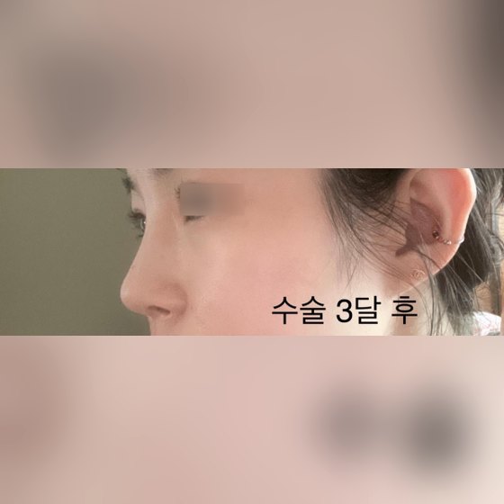 코성형 후기 게시글 썸네일 — 완전 만족하는 코성형 3개월차입니당 ㅎㅎ