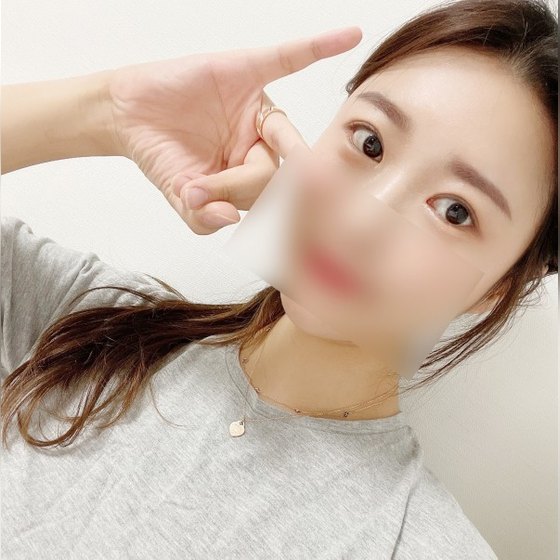 Ảnh thu nhỏ bài review thẩm mỹ mắt — Mình đã phẫu thuật sửa lại mắt xúc xích rồi nè haha