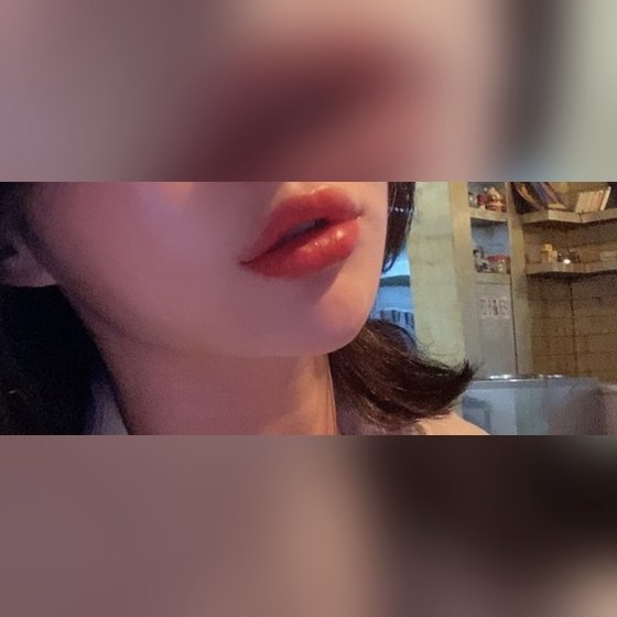 Ảnh thu nhỏ bài review thẩm mỹ không phẫu thuật — Đúng là địa chỉ tiêm filler đỉnh luôn hihi